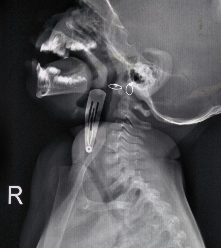 1.5 Yr Old Boy Swallowed 4cm Tic Tac Hair Pin 4 IMG 20190325 WA0019 1